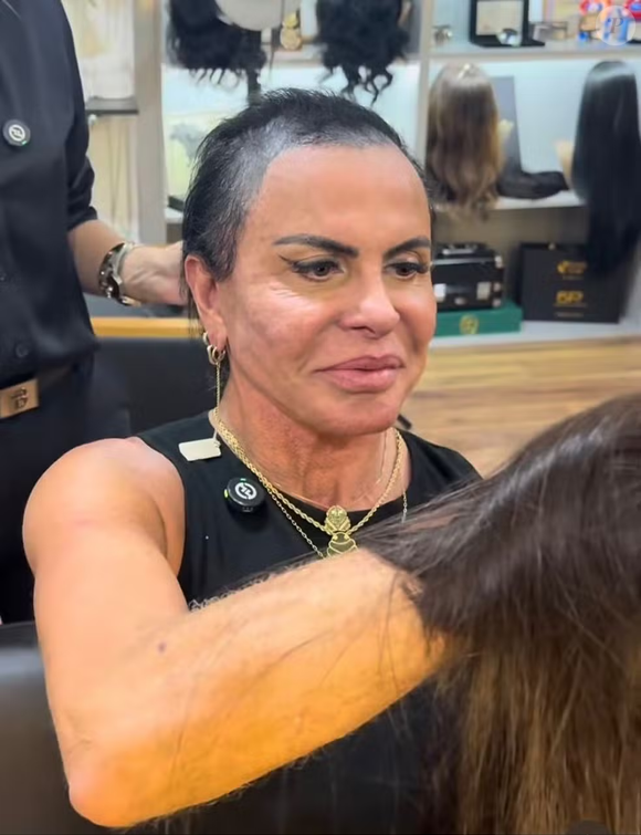 Gretchen relata que a micropigmentação capilar contribuiu para uma piora na queda dos fios. Atualmente, a artista conta com a ajuda de próteses capilares