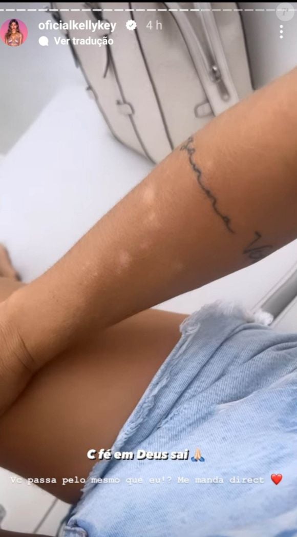 Fatores relacionados à vida urbana podem causar manifestações da psoríase, doença que afeta Kelly Key