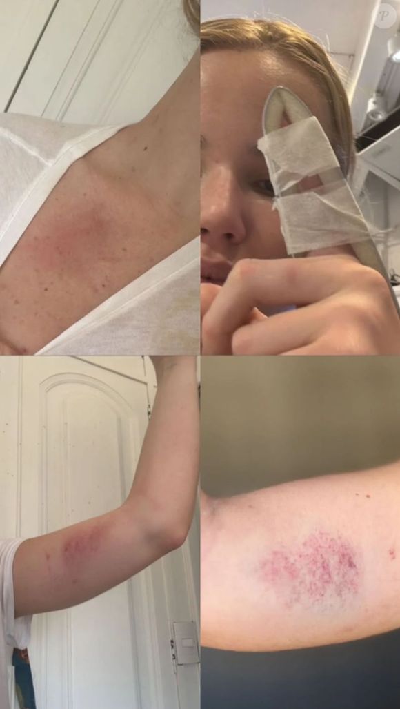 Marcela Tomaszewski surgiu com marcas vermelhas no corpo supostamente após ser agredida por Dado Dolabella