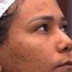 Pele acneica: quais são os cuidados ideais para quem tem, como Chaiany, eliminada do 'BBB 26'? Cosmetóloga faz alerta e revela hábito indispensável na rotina de skincare