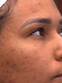 Pele acneica: quais são os cuidados ideais para quem tem, como Chaiany, eliminada do 'BBB 26'? Cosmetóloga faz alerta e revela hábito indispensável na rotina de skincare