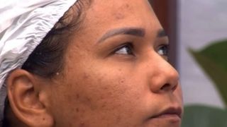 Pele acneica: quais são os cuidados ideais para quem tem, como Chaiany, eliminada do 'BBB 26'? Cosmetóloga faz alerta e revela hábito indispensável na rotina de skincare