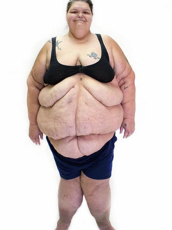 Depois de passar por uma cirurgia bariátrica, Robin eliminou 115 quilos, chegando aos 179 quilos