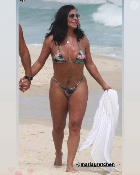 Gretchen realizou ninfoplastia com accutite, um dispositivo de radiofrequência (RF) minimamente invasivo, que ajuda a remodelar e firmar a pele e reduz a flacidez