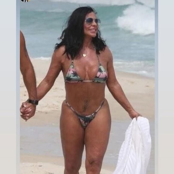 Gretchen realizou ninfoplastia com accutite, um dispositivo de radiofrequência (RF) minimamente invasivo, que ajuda a remodelar e firmar a pele e reduz a flacidez