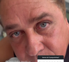Resultado da blefaroplastia de Leonardo foi elogiada por Poliana Rocha: ‘Ele rejuvenesceu dez anos’