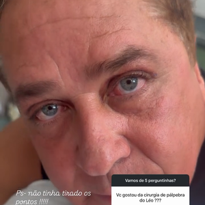 Resultado da blefaroplastia de Leonardo foi elogiada por Poliana Rocha: ‘Ele rejuvenesceu dez anos’