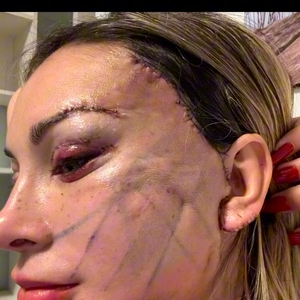 Cirurgia de Andressa Urach custou R$ 100 mil e está longe de ficar completamente cicatrizada, mas resultado já choca