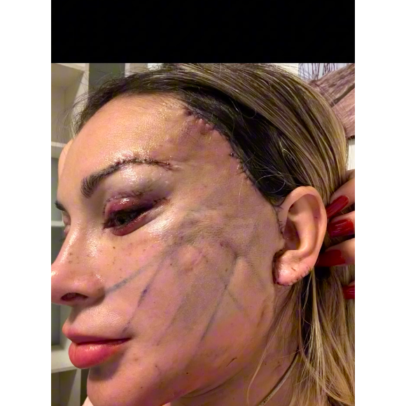 Cirurgia de Andressa Urach custou R$ 100 mil e está longe de ficar completamente cicatrizada, mas resultado já choca
