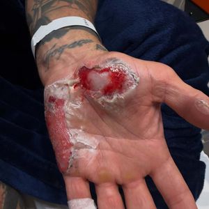 Depois da repercussão sobre sua ausência no reality da Band, Henrique Fogaça publicou fotos dos ferimentos e rebateu críticas, dizendo que sempre foi comprometido com o trabalho