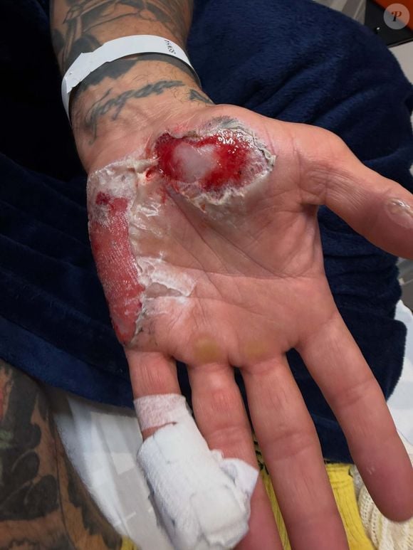 Depois da repercussão sobre sua ausência no reality da Band, Henrique Fogaça publicou fotos dos ferimentos e rebateu críticas, dizendo que sempre foi comprometido com o trabalho