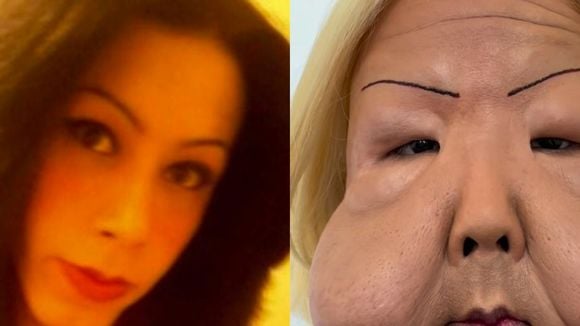 O que aconteceu com Juju do Pix? A linha do tempo da tragédia vivida por influenciadora do RS após injetar óleo mineral no rosto; antes e depois é chocante