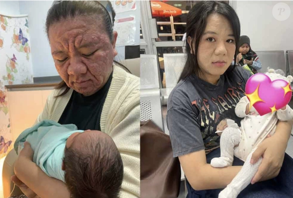 A jovem desenvolveu uma erupção cutânea vermelha por todo o rosto e agora está tentando lidar com a situação, meses após o nascimento do bebê.