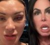 Andressa Urach foi comparada a Gretchen ao mostrar o antes e depois de mais uma plástica no rosto