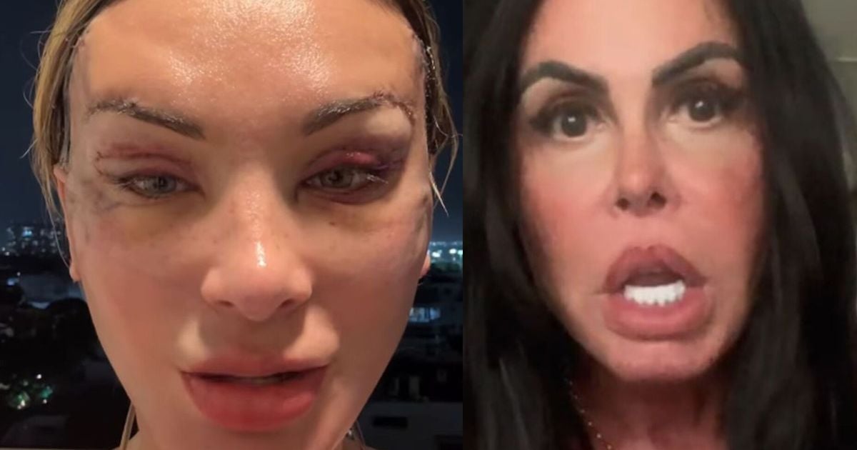 Andressa Urach choca ao aparecer com rosto deformado após cirurgia plástica