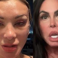 'Estou irreconhecível': Andressa Urach surge com rosto deformado após plástica e web reage. 'A nova Gretchen'