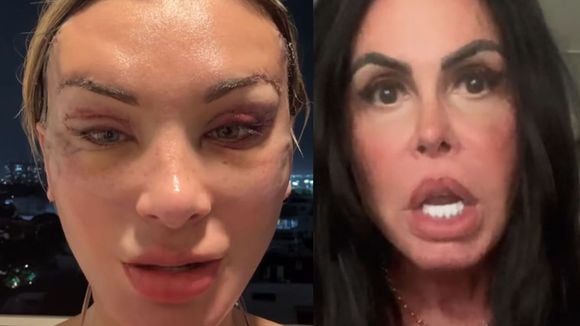 'Estou irreconhecível': Andressa Urach surge com rosto deformado após plástica e web reage. 'A nova Gretchen'