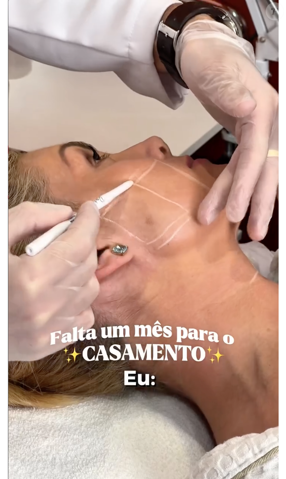 Para encerrar seu protocolo, Ana Hickmann também realizou skinboosters, ultrassom micro e macrofocado e o laser Thulium