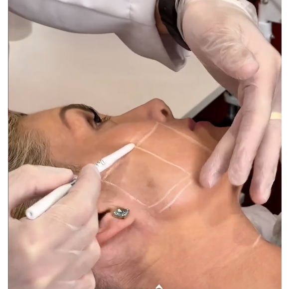 Para encerrar seu protocolo, Ana Hickmann também realizou skinboosters, ultrassom micro e macrofocado e o laser Thulium