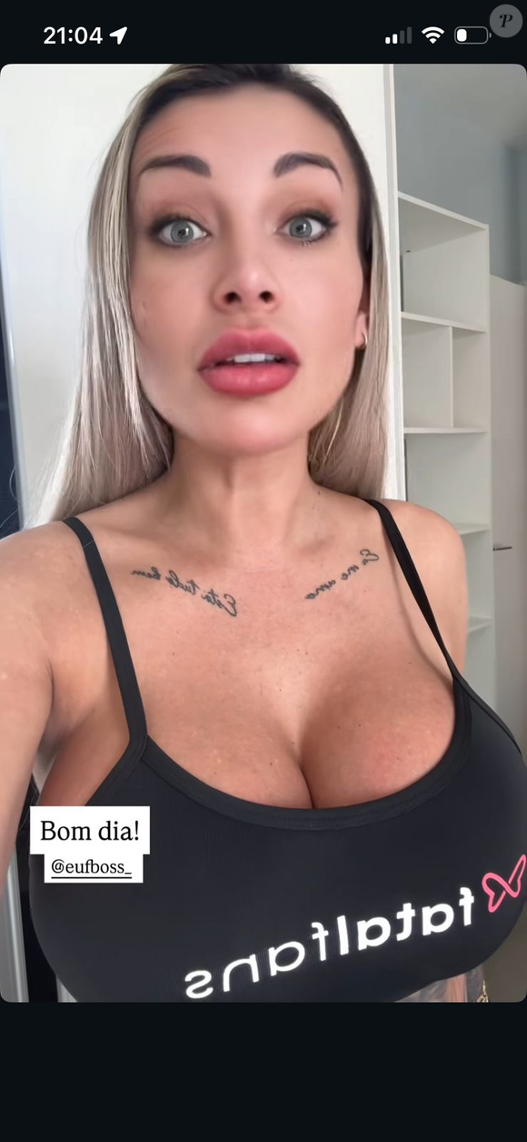 Solteira após o término conturbado com Flávio Gigioli, Andressa Urach passou por uma nova cirurgia em seu rosto