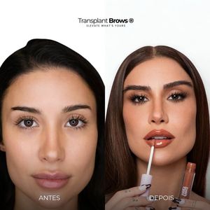 Procedimento compartilhado por Boca Rosa chama atenção pela precisão: 'A sobrancelha exige um nível de detalhamento ainda maior do que o transplante capilar tradicional', afirma João Gabriel Nunes
