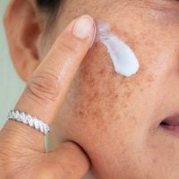 Melasma: especialista revela que clima ameno e a menor exposição solar no inverno favorecem tratamentos; veja como cuidar da pele