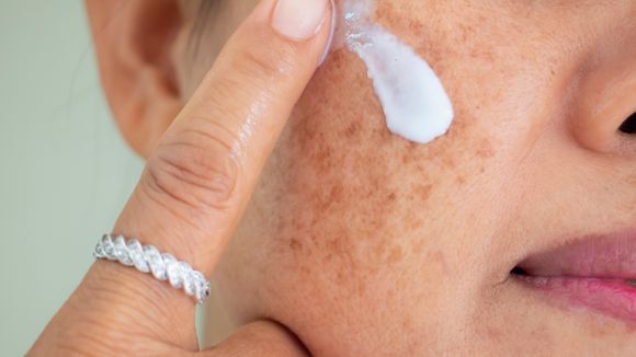 Melasma: especialista revela que clima ameno e a menor exposição solar no inverno favorecem tratamentos; veja como cuidar da pele