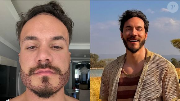 O ex-BBB Eliezer aliou o transplante capilar a um transplante de barba, renovando seu visual