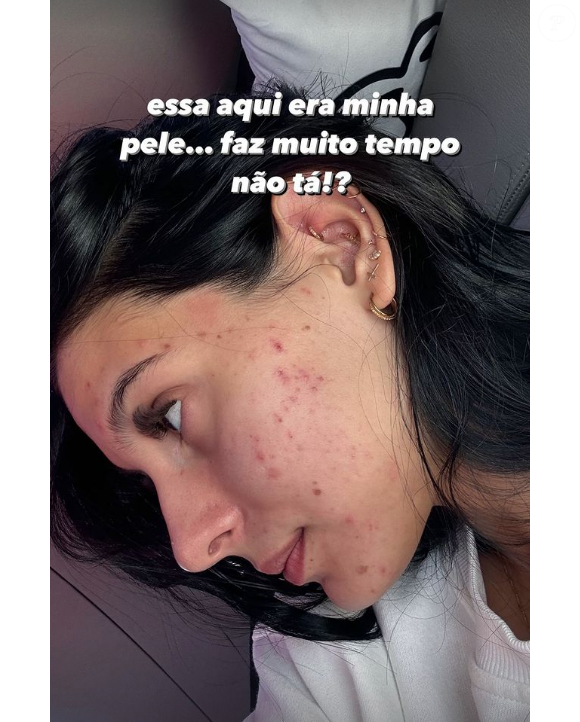Segundo a dermatologista Laís Rios, o uso da isotretinoína deve sempre ser criterioso e individualizado.