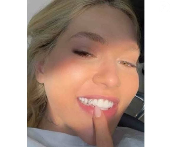 Segundo a Coluna Veja Gente, a popularização do tooth gem entre famosas ajuda a transformar o acessório em uma tendência de estética, mas o odontologista Leonardo Acioli ressalta que a escolha precisa ser acompanhada de cuidados com a saúde bucal