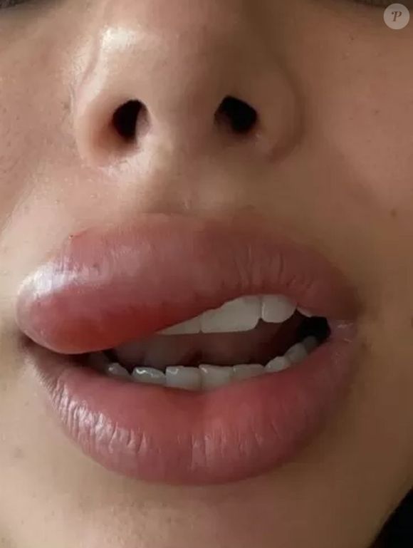 Bruna Biancardi mostrou que ficou com parte do rosto deformado após adquirir uma 'celulite infecciosa'