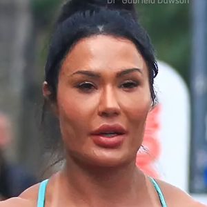 Gracyanne Barbosa resolveu reverter os procedimentos estéticos do seu rosto há alguns meses