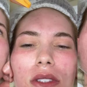 'Primeiro feia, depois bonita': Virginia Fonseca exibe rosto inchado após 'combo' de procedimentos (até no bumbum!)