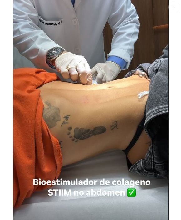 Virgínia Fonseca também realizou um bioestimulador de colágeno em seu corpo