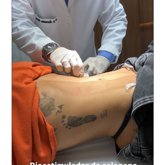 Virgínia Fonseca também realizou um bioestimulador de colágeno em seu corpo