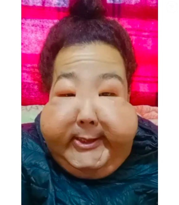 Juju do Pix ficou completamente inchada e irreconhecível