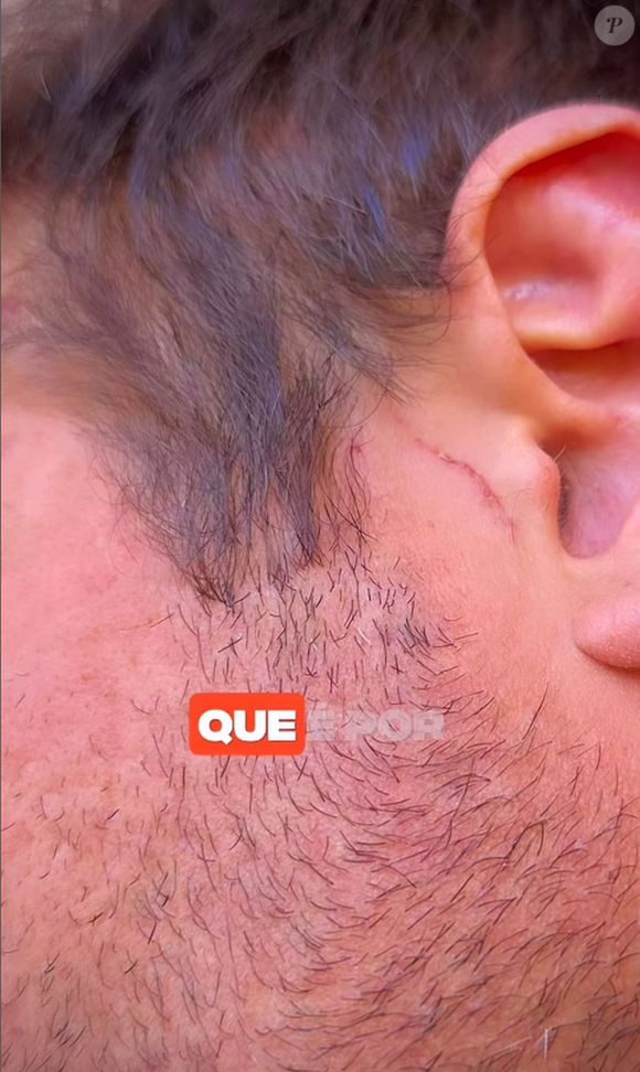 Dado Dolabella mostrou o rosto machucado após supostamente ter levado um tapa de Marcela Tomaszewski