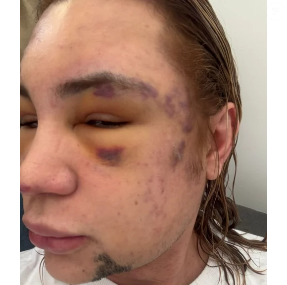 Junior Lima denunciou o profissional e o acusou de fraude. Segundo o influenciador, era um dentista que se passava por médico especialista em cirurgia da face