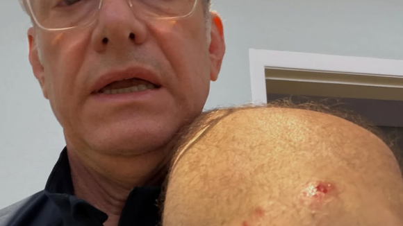 Âncora da Globo, José Roberto Burnier leva 4 pontos após ataque de pitbull sem guia: ‘O preço da irresponsabilidade’