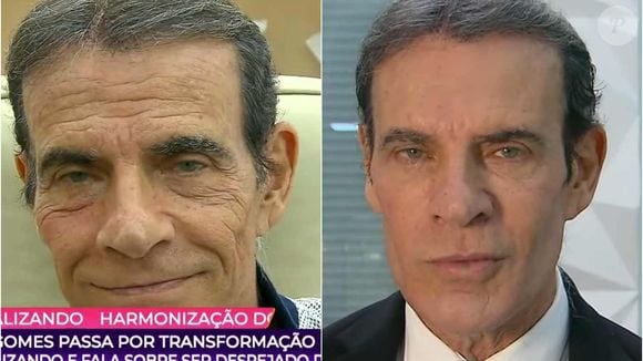 Antes e depois de Mário Gomes: com a ajuda do 'Fofocalizando', ator mudou o rosto com harmonização facial e rejuvenesceu muito