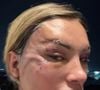 Andressa Urach está mostrando o dia a dia após o procedimento cirúrgico