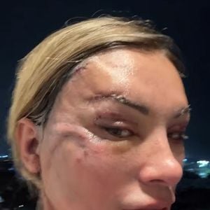 Andressa Urach está mostrando o dia a dia após o procedimento cirúrgico