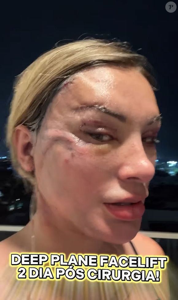 Andressa Urach está mostrando o dia a dia após o procedimento cirúrgico