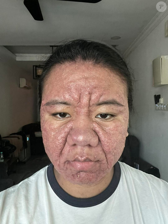 Em sua conta, Farah disse que, segundo seu médico, o diagnóstico era apenas um hormônio da gravidez. "No primeiro trimestre, apenas pequenas bolinhas. No segundo trimestre, minha pele ficou mais grossa, com linhas de expressão e de expressão visíveis e mais grossas", esclareceu, tirando as dúvidas dos seguidores.
