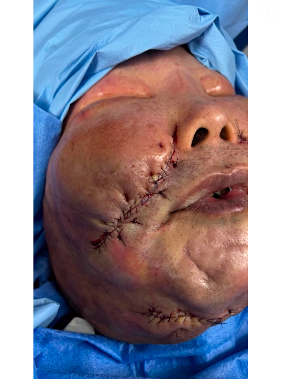 Segundo o médico, o procedimento foi delicado e as cicatrizes de Juju do Pix ficarão na região do bigode chinês e abaixo do queixo