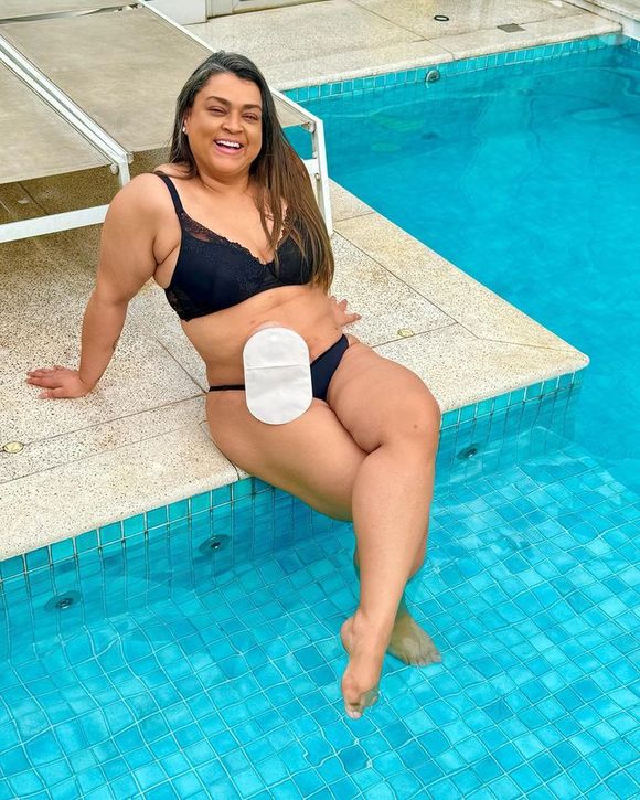 Bolsas de colostomia e ileostomia precisam de cuidados mas podem pegar água e sabão no banho