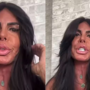 Gretchen passou recentemente por um novo procedimentos estéticos mas, desta vez, para retirar preenchedores