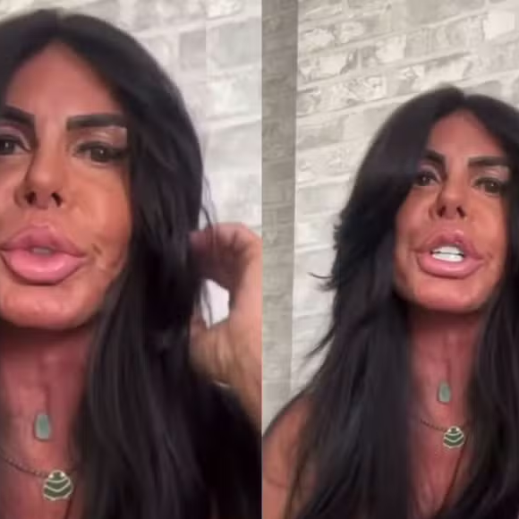 Gretchen passou recentemente por um novo procedimentos estéticos mas, desta vez, para retirar preenchedores