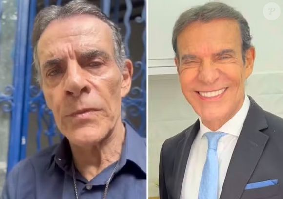 Mário Gomes fez preenchimentos nos lábios, mandíbula, na região malar e no bigode chinês, aplicou botox e fez lasers no rosto