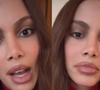 Sem 'pé na cova', sem cara 'desfigurada': Anitta fala pela 1ª vez sobre nova plástica no rosto. 'Eu sempre fiz, mas…'